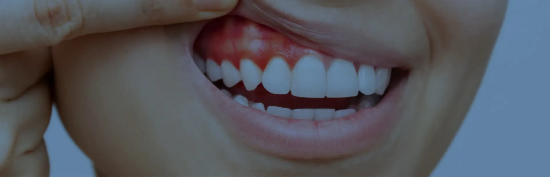 DİŞ ETİ ESTETİĞİ (Diş Eti Gülüşü Tedavisi ve Diş Eti Şekillendirme)