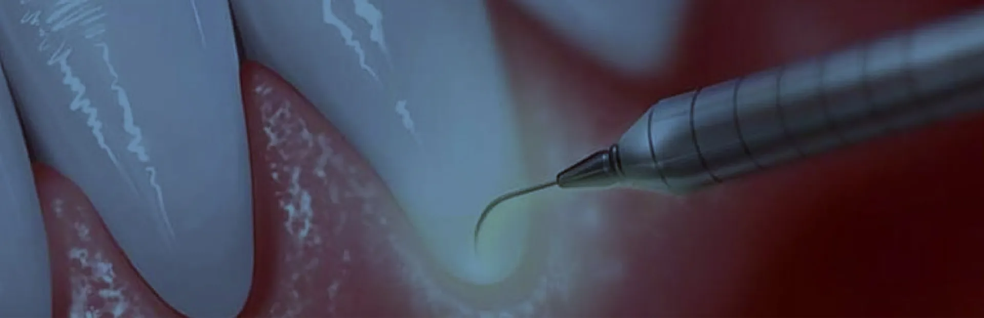 ESTETİK DİŞ ETİ ŞEKİLLENDİRME