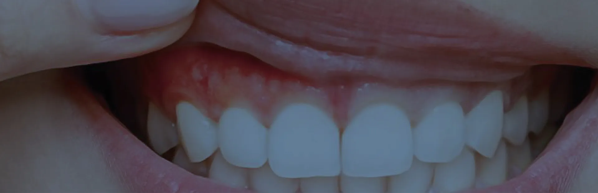 PORSELEN-METAL (PFM) RESTORASYONLAR