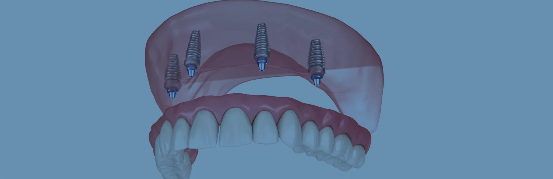 Tam Kemer İmplant Sistemleri (All-on-4 / All-on-6)