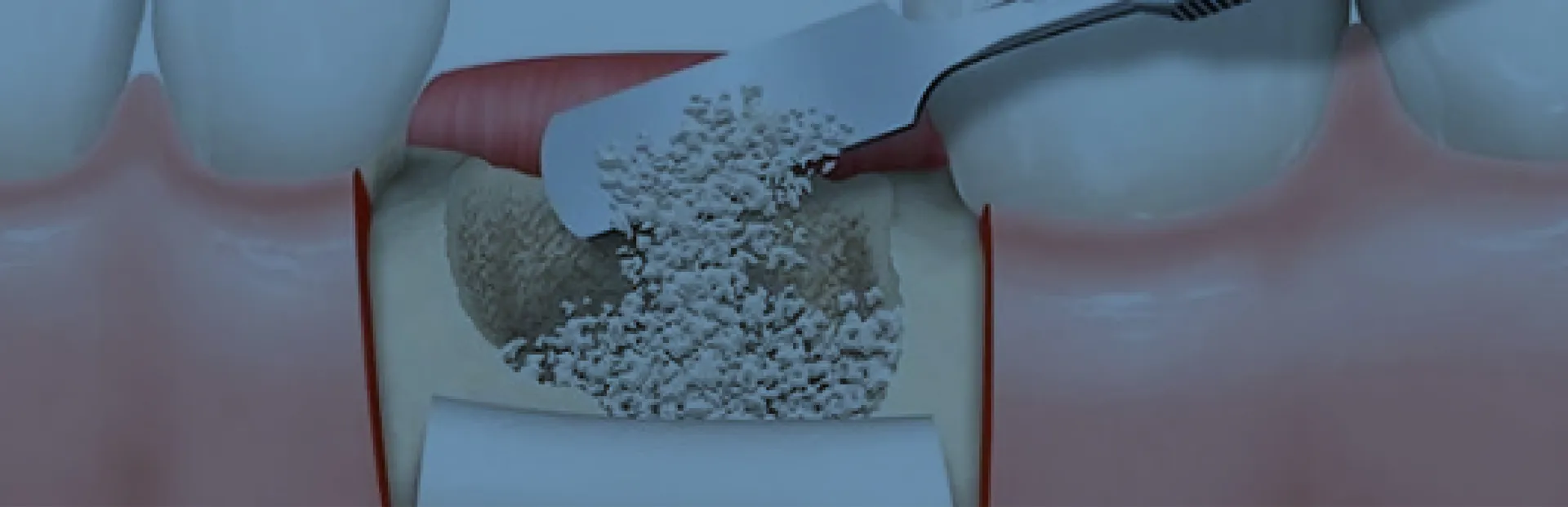 Kemik Grefti (Kemik Tozu / Kemik Grefti Uygulaması)