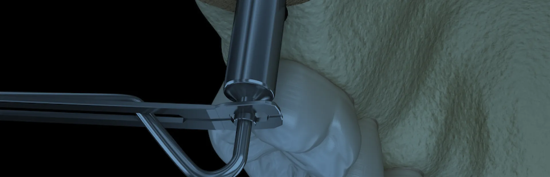 Sinüs Kaldırma (Açık ve Kapalı Sinüs Kaldırma)