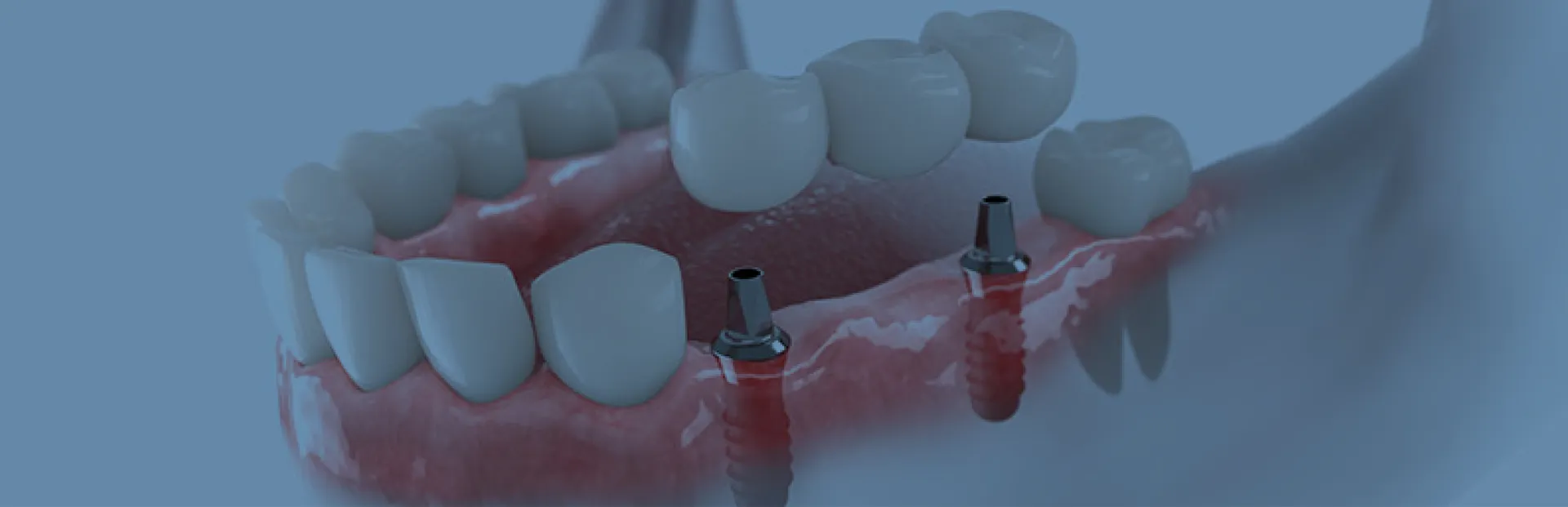 Sabit ve Çıkarılabilir İmplant Destekli Protezler