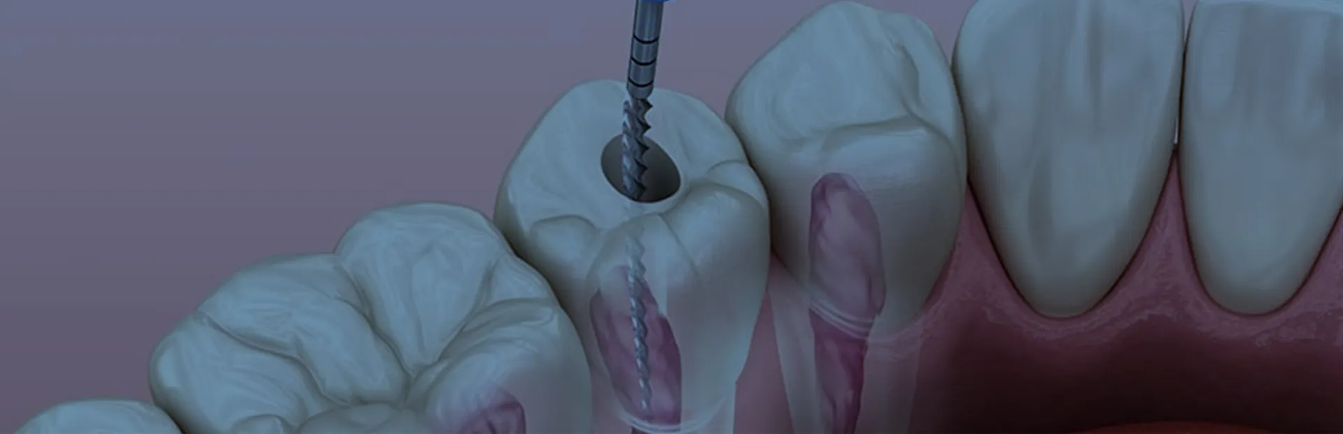 Standart Kök Kanal Tedavisi