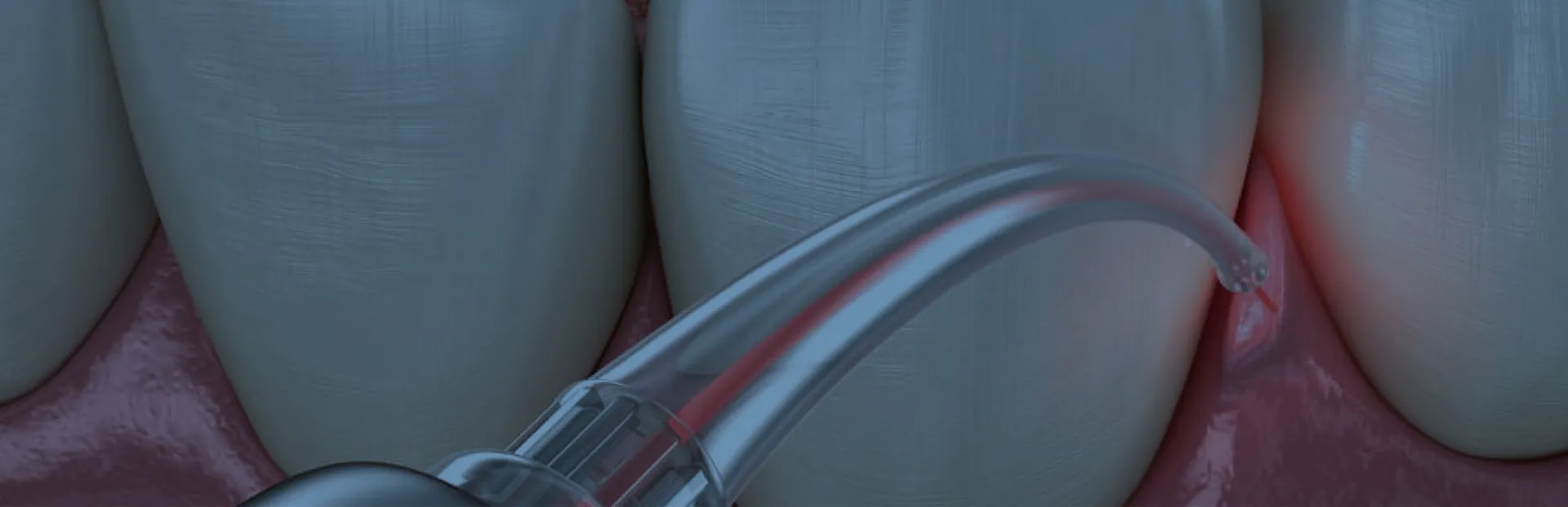 Apikal Rezeksiyon (Kök Ucu Cerrahisi / Apikektomi)