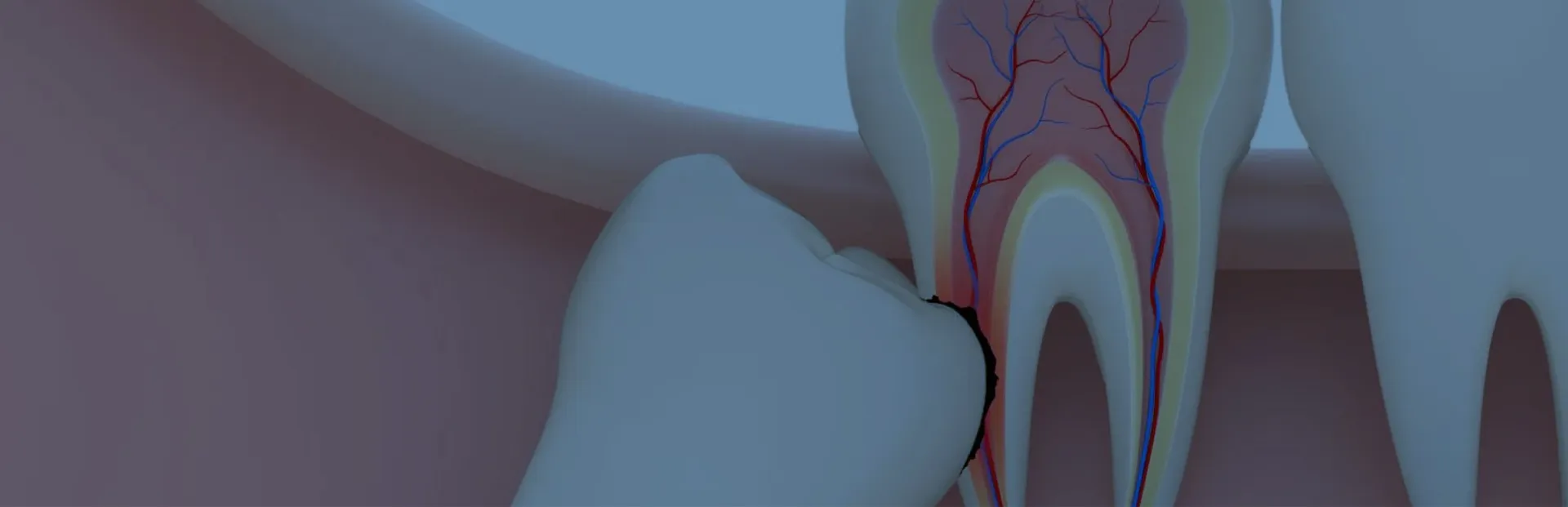 Gömülü ve Zor Diş Çekimi