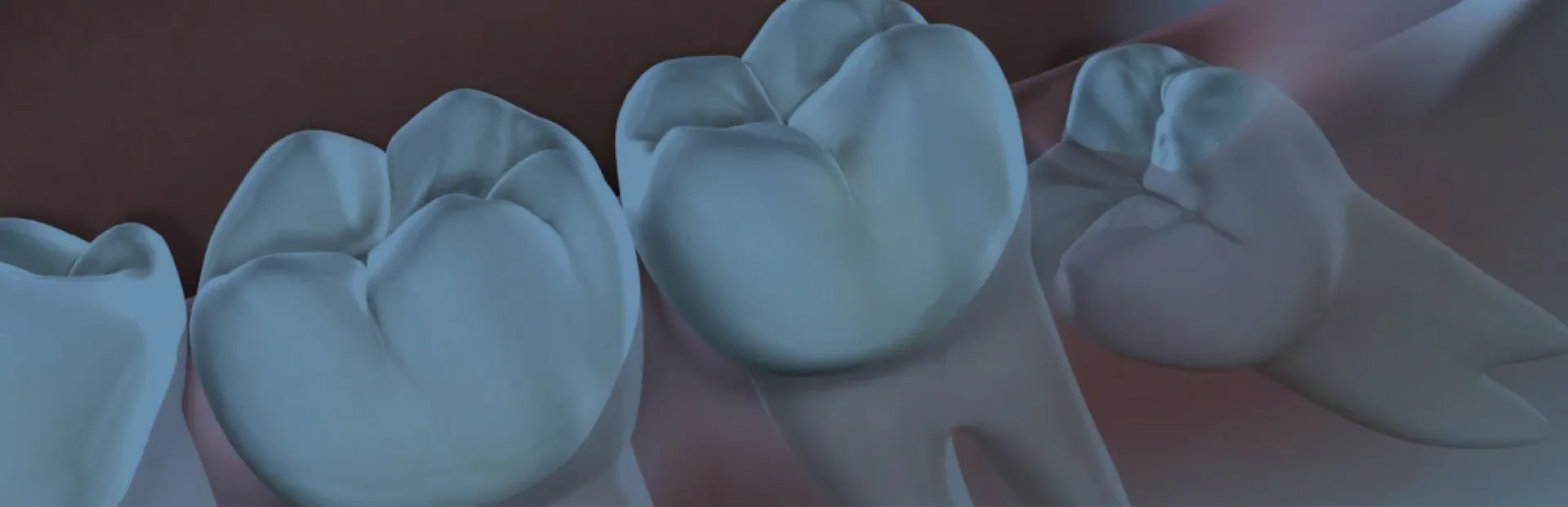 Gömülü 20 Yaş Dişi Çekimi